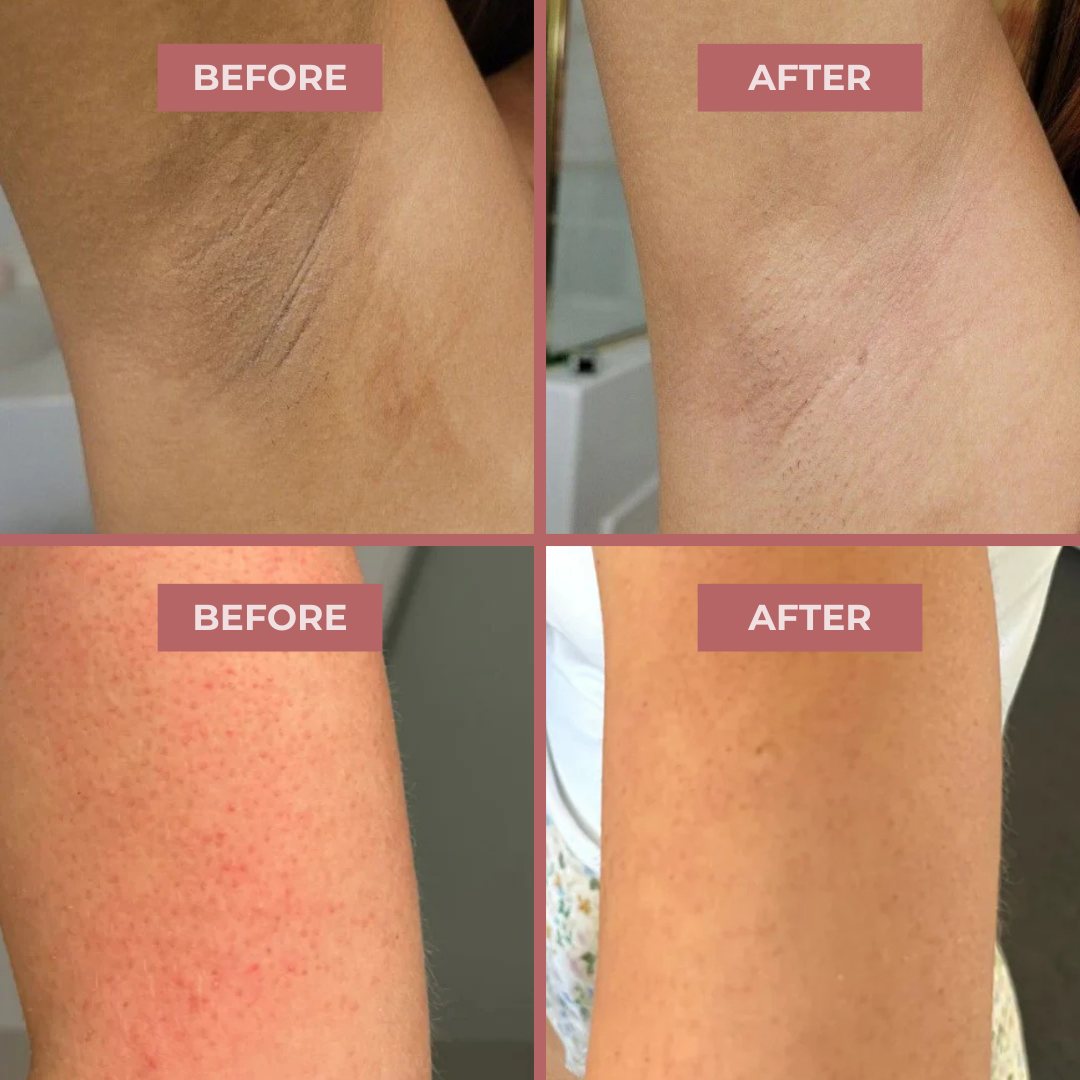 BODY PEEL SHOT 99% Pure Kojic Acid + Turmeric